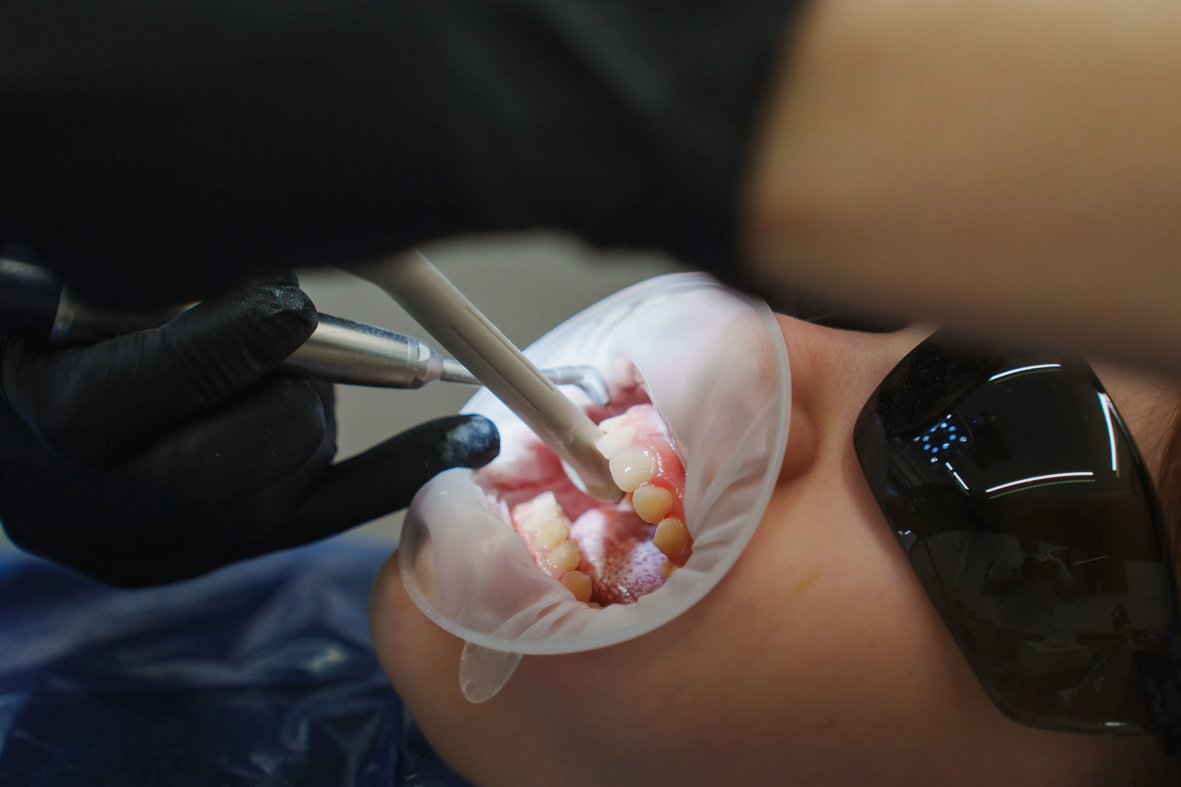 Fluoride Treatment