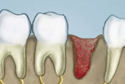 Tooth Socket Original9