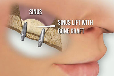 Sinus Lift2 Original21